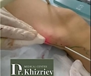 Лечение варикоза в МЦ Доктора Хизриева в объявлении 1 фото Лечение варикоза в МЦ Доктора Хизриева картинка из объявления